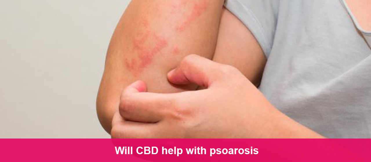 Will CBD help with psoarosis